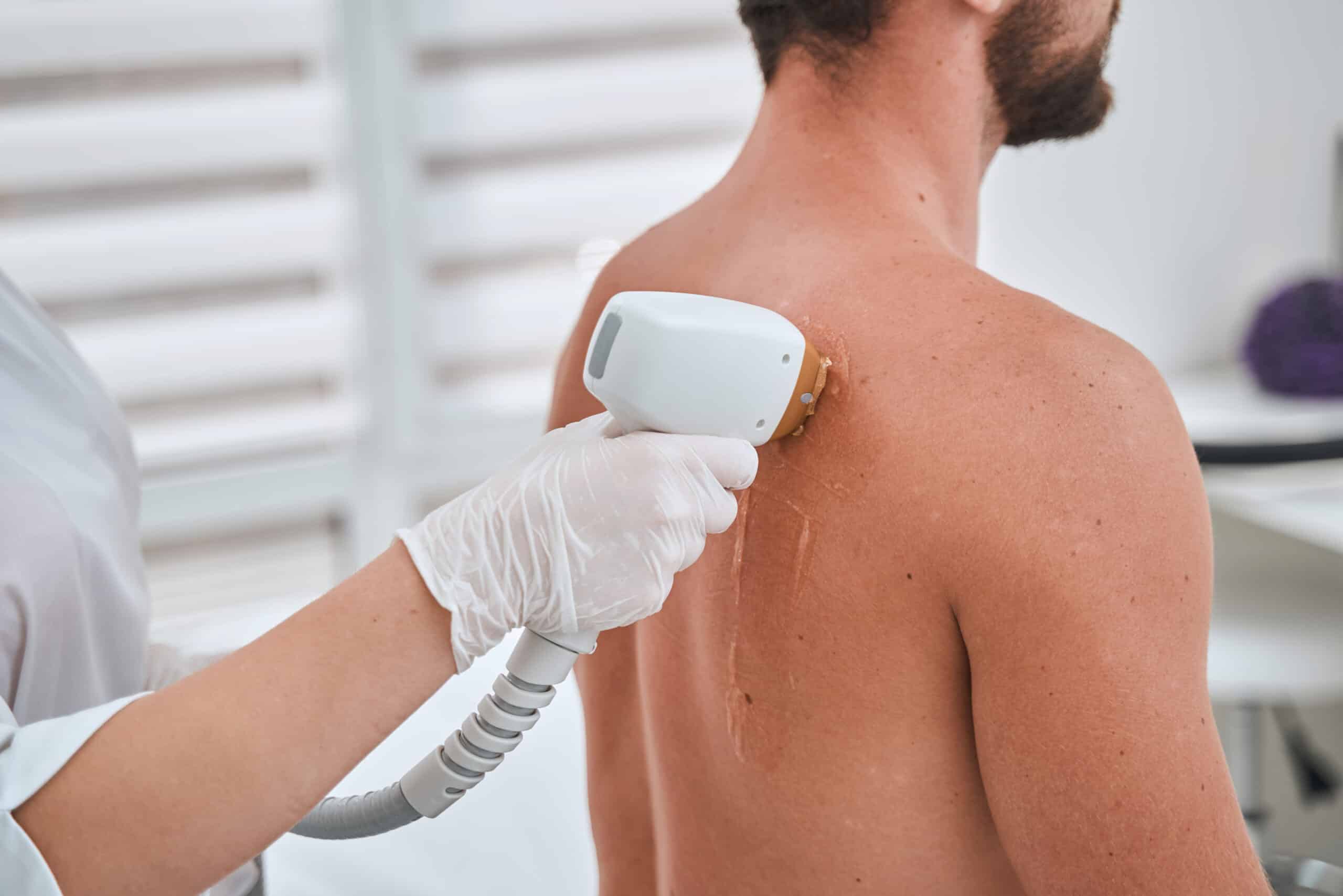 epilation du dos au laser